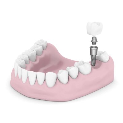 Illustration of dental - implants