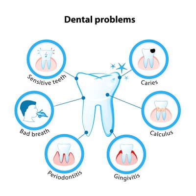 periodontal-disease