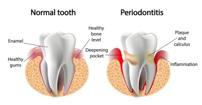 periodontal - disease