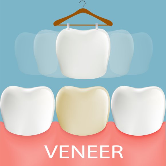 veneers