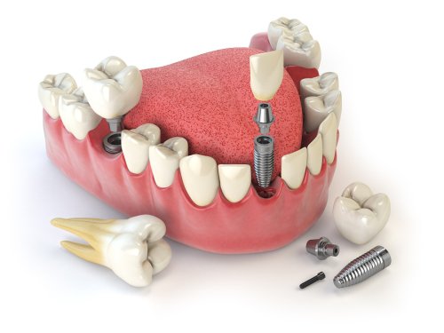 dental - implants