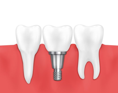 Illustration of dental implant