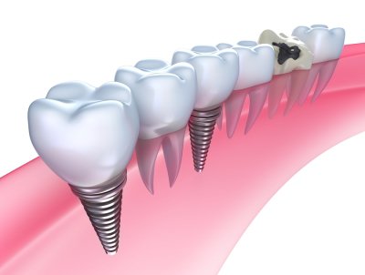 Illustration of dental - implants