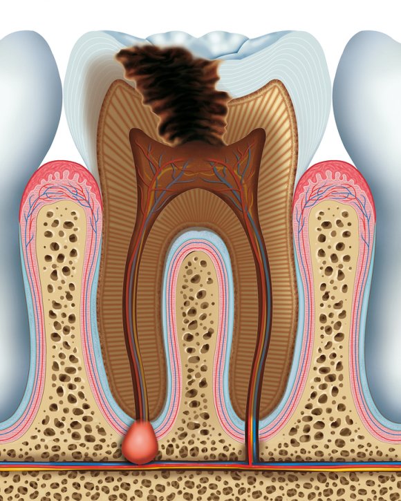 Tooth-Loss-Bone