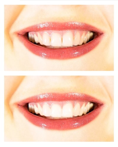 Whiter-Teeth