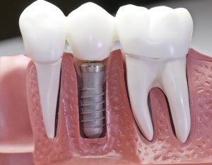Dental Implants Peoria