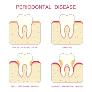 Periodontal Disease Peoria
