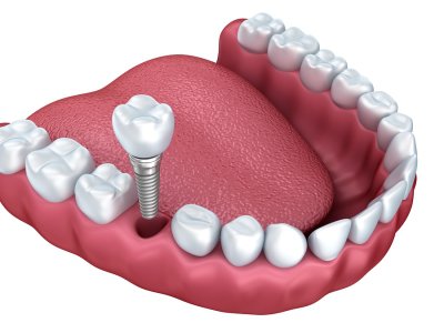 dental implants