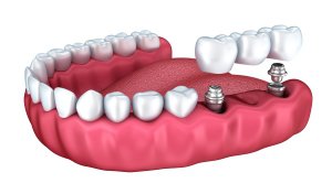 Dental Implants Creve Coeur