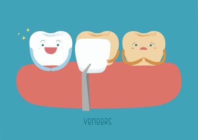 veneers graphic