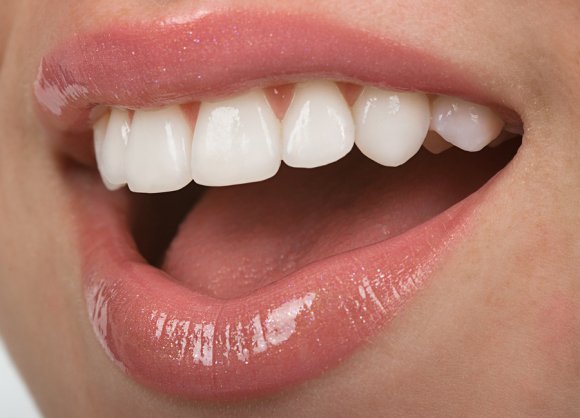 Tooth Veneers in Creve Coeur, IL